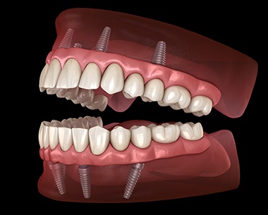 Animated dental implant supported denture