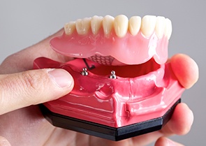 Model ball retained dental implant denture