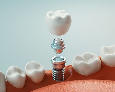 Animated smile during dental implant supported dental crown placement