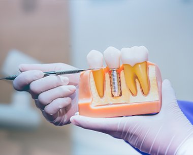 Model of natural teeth and dental implant supported replacement tooth