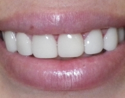 Bright healthy smile after dental care
