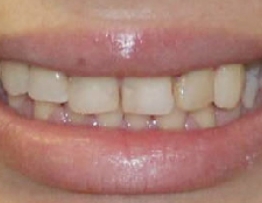 Damaged and discolored teeth before dental care