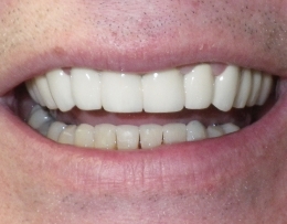 Healthy happy smile after tooth replacement