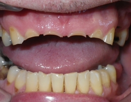 Severely worn and decayed teeth before tooth replacement
