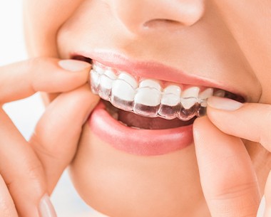 Woman placing an Invisalign tray