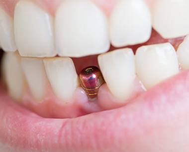 Closeup of smile with dental implant post