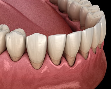 Smile with receding gums in need of laser periodontics