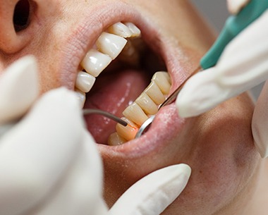 Patient receiving laser dentistry before tooth desensitization