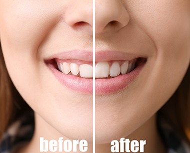 Closeup of smile before and after laser cosmetic treatments
