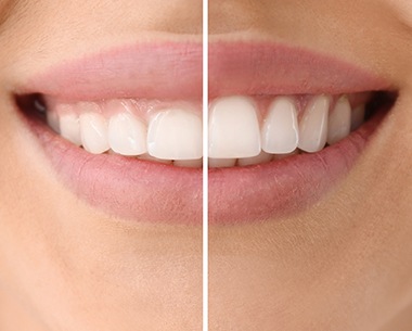Smile before and after crown lengthening