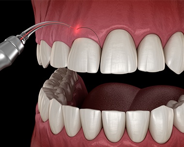 Animated smile during gingivoplasty treatment