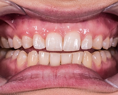 Closeup of smile after gum pigmentation removal
