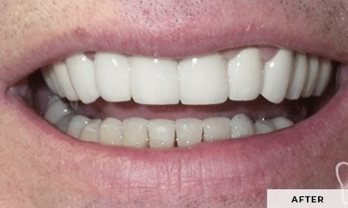 smiling patient