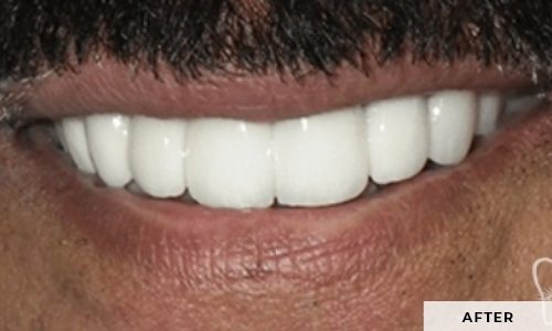 smiling patient
