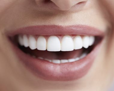 Closeup of flawless smile after Lumineer treatment