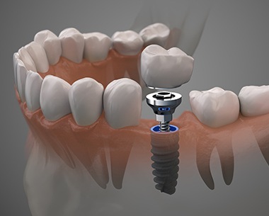 Animated smile during dental implant supported dental crown placement