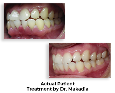 Smile before and after laser gum surgery