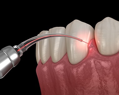 Animated smile during laser gum treatment using the lastest technology