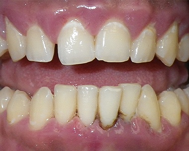 Closeup of smile with damaged soft tissue due to periodontal disease