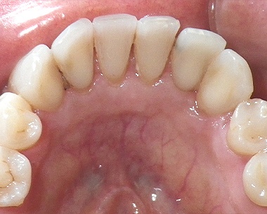 Closeup of smiling during periodontal maintenance exam