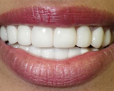 Closeup of smile after emergency dentistry