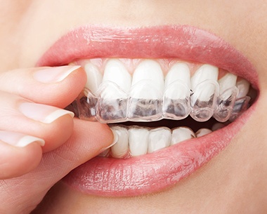 Closeup of patient placing a SureSmile aligner