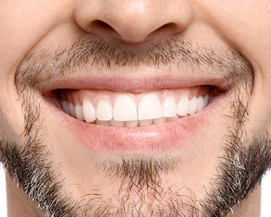 Patient's smile in tooth color shade matching system