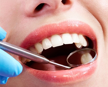Dentist examining patient's tooth colored filling restoration