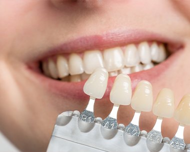 Patient's smile compared with porcelain veneer shade chart
