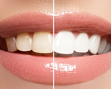 Closeup of smile before and after teeth whitening