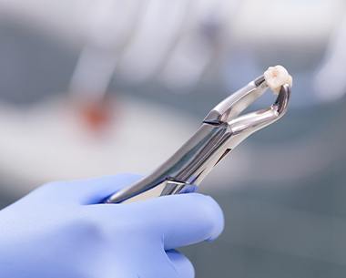 Metal clasp holding an extracted wisdom tooth