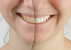 Your dentist for Zoom Whitening in Holbrook.