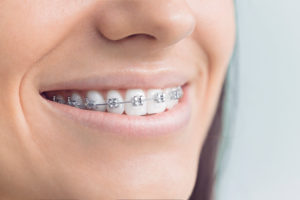 Discover your options for braces in Sayville.