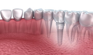 Treat your tooth loss with dental implants in Sayville. 