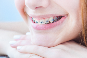 Young woman with braces