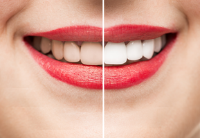 Before and after teeth whitening