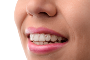 woman wearing Invisalign