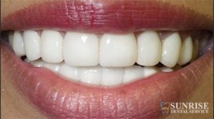 smile with veneers