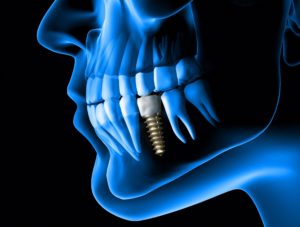 digital representation of dental implant