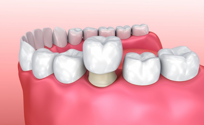 a dental crown