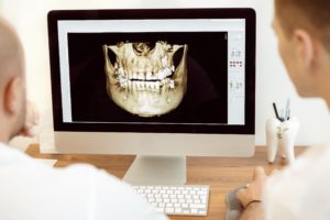 3D image of jaw for dental implants.