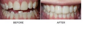 Before and after Invisalign treatment