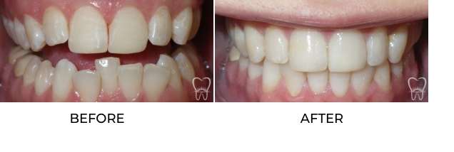 Before and after Invisalign