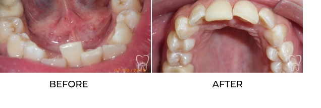Patient’s misaligned upper and lower teeth