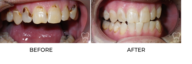 Before and after cosmetic dental bonding