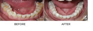 Before and after bruxism treatment