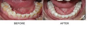 Before picture of patient with enamel loss