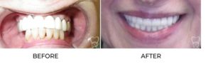 Before and after denture from Dr. Makadia