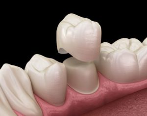 Illustration of porcelain dental crown being placed on tooth