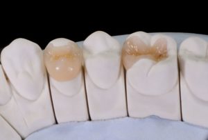 Two dental onlays on detailed tooth model
